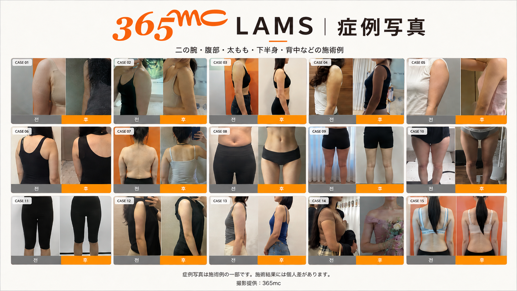 365mc LAMS症例写真15例
