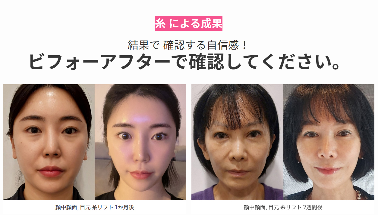 PANG PANG CLINIC 糸リフト症例 ビフォーアフター