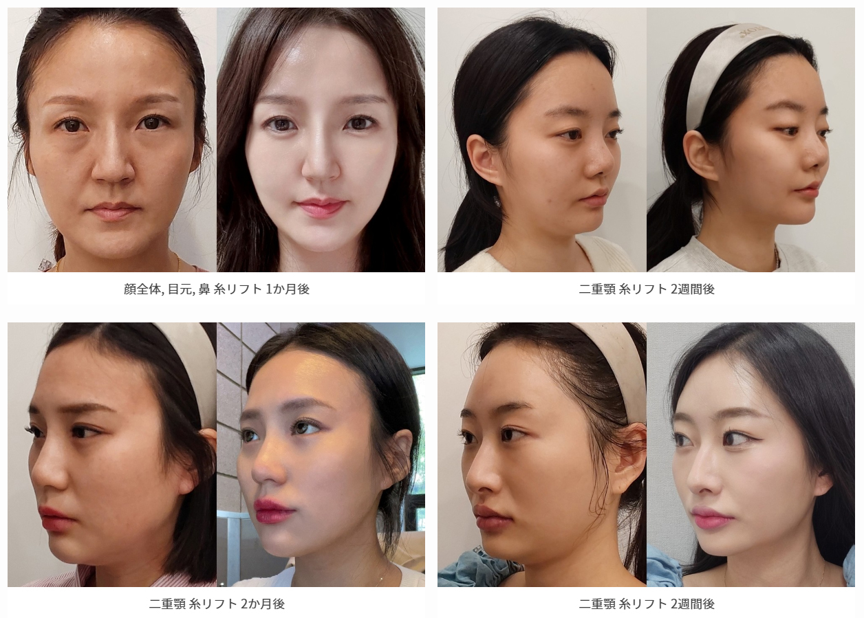 PANG PANG CLINIC 糸リフト症例