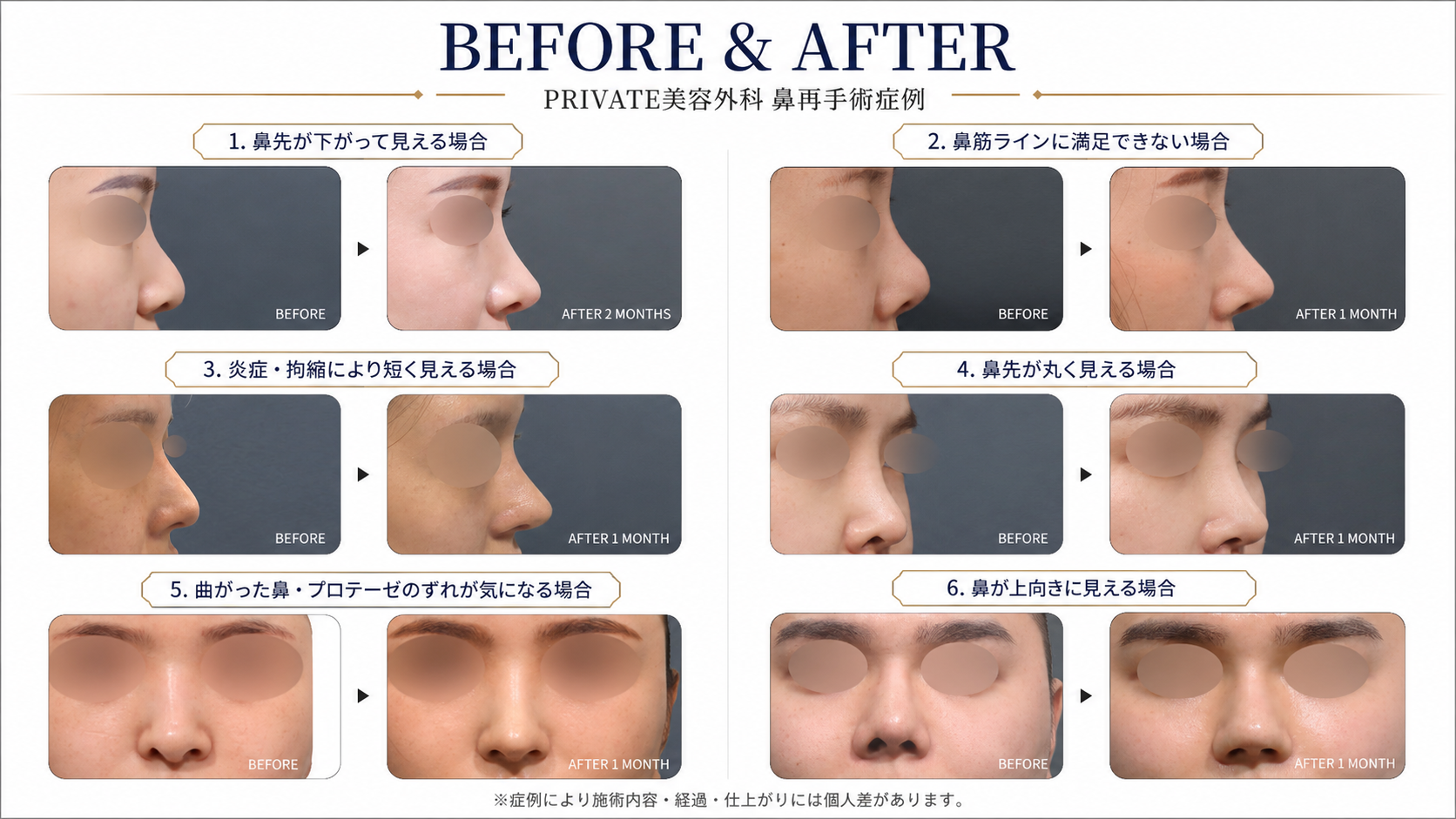 PRIVATE美容外科 鼻再手術 BEFORE AFTER 症例
