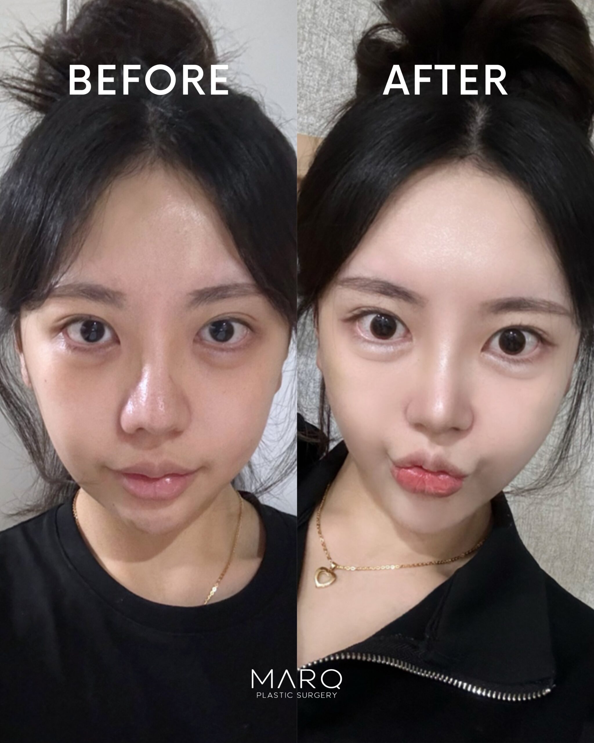 MARQ美容外科 鼻整形 症例