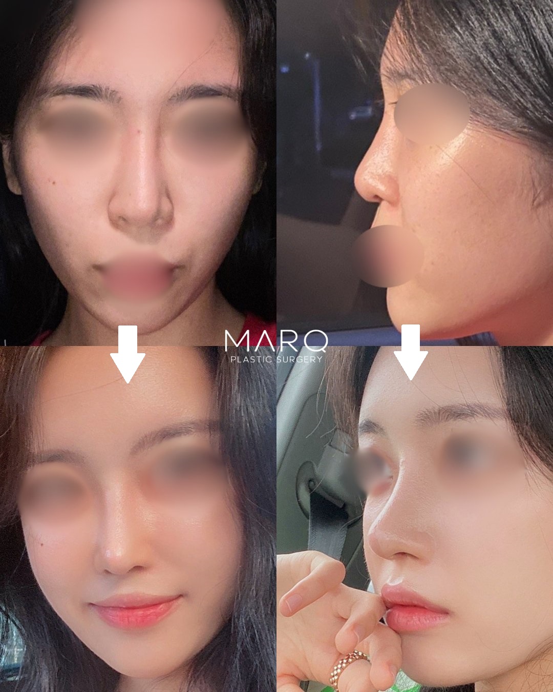 MARQ美容外科 鼻整形 症例