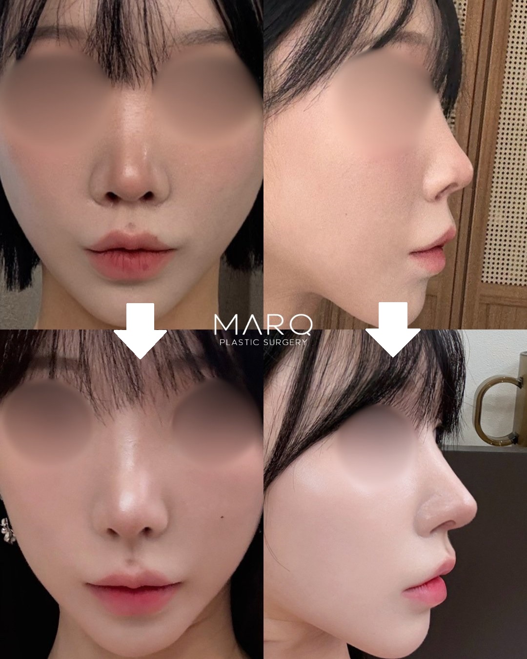 MARQ美容外科 鼻整形 症例