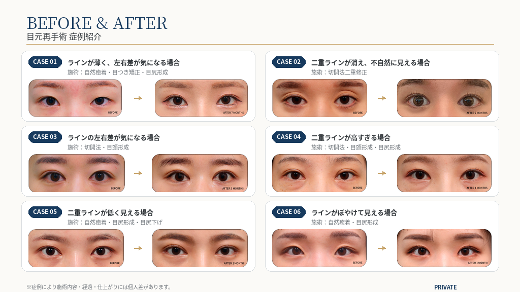 PRIVATE美容外科 目元再手術 BEFORE AFTER 症例