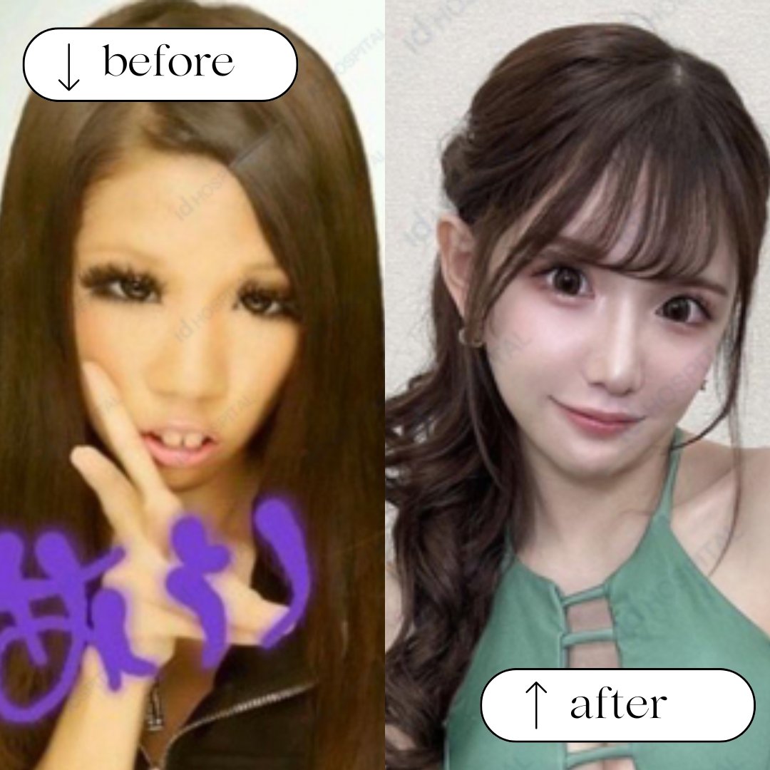 輪郭施術 ビフォーアフター