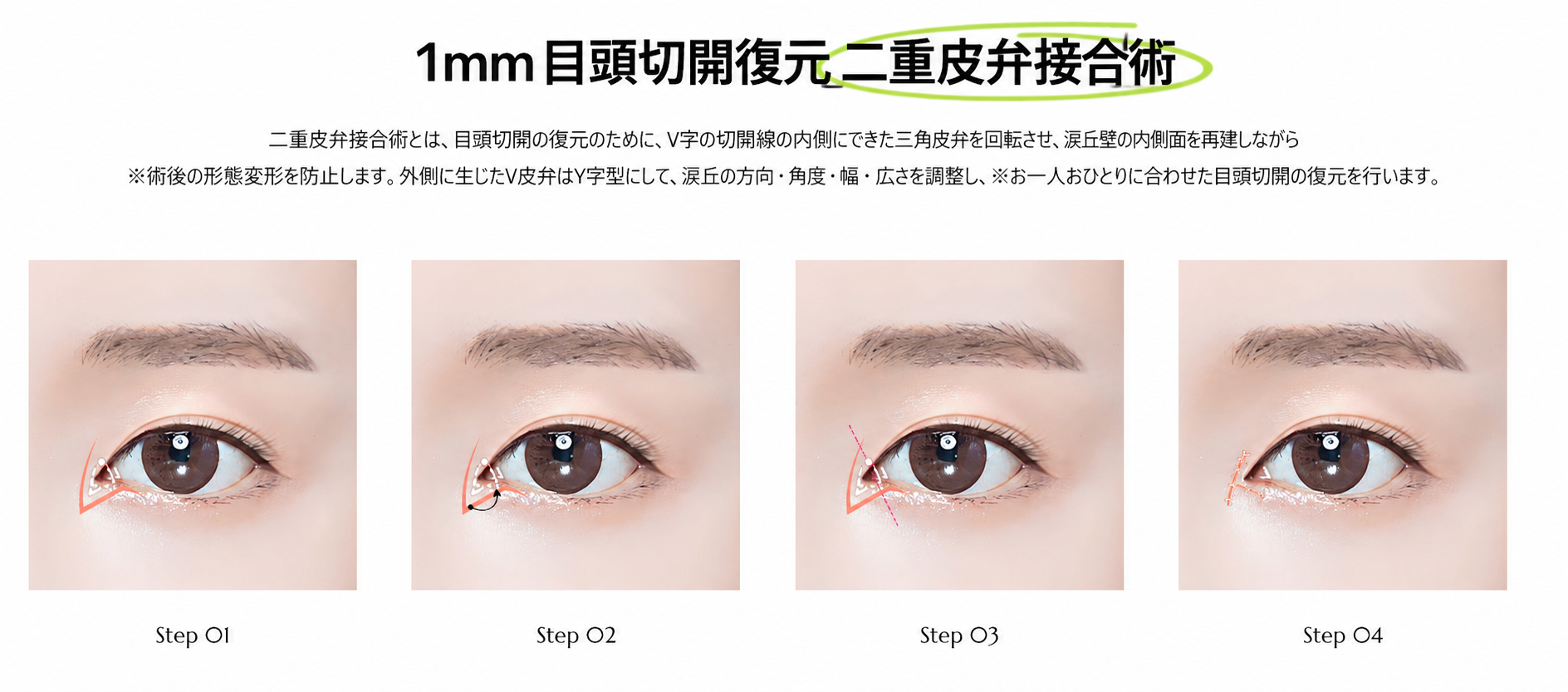 1mm美容外科 目頭復元 イメージ