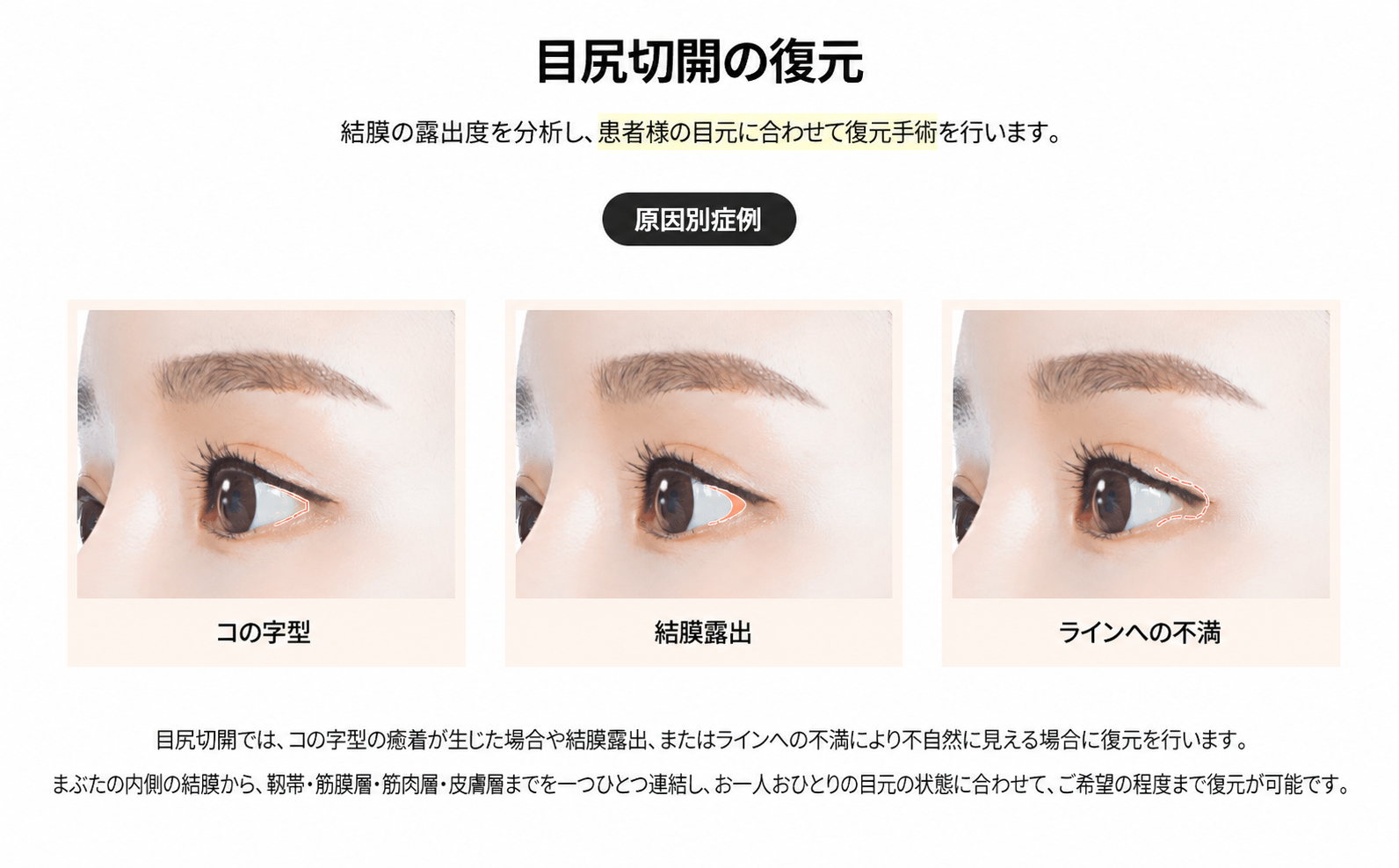 1mm美容外科 目尻復元